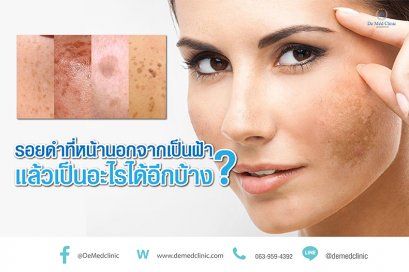 รอยดำที่หน้านอกจากเป็นฝ้า แล้วเป็นอะไรได้อีกบ้าง?